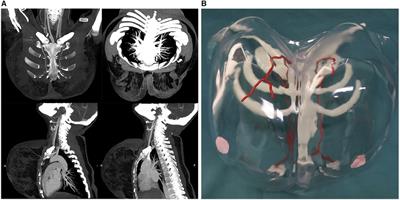 Innovative Application of Three-Dimensional-Printed Breast Model-Aided Reduction Mammaplasty